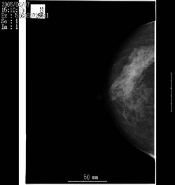 撮影された乳房X線写真
