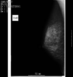 撮影された乳房X線写真