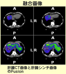 アイソトープ｜融合画像　肝臓CT画像と肝臓シンチ画像のFusion｜放射線科