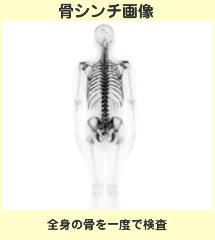 アイソトープ｜骨シンチ画像 全身の骨を一度で検査｜放射線科