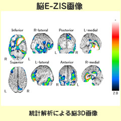 アイソトープ｜脳E-ZIS画像 統計解析による脳３D画像｜放射線科